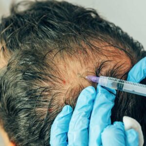 Plasma Injection for Hair Growth: A Natural Path to Renewed Confidence
